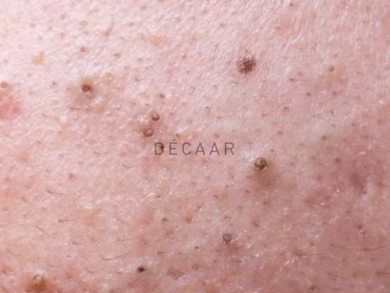 có nên nặn mụn đầu đen ở mũi không